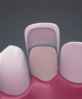 veneers shown against a tooth